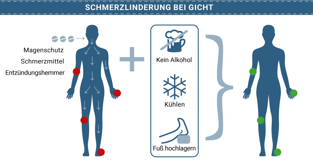 Infografik: Medikamente gegen Schmerzen beim Gichtanfall