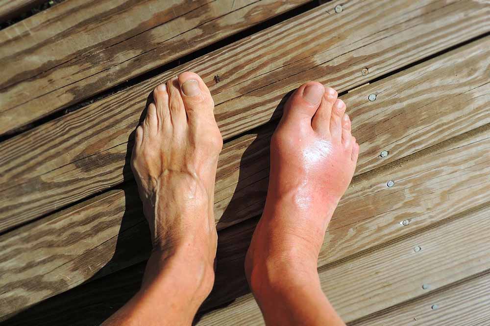 Gichtanfall im rechten Fuß