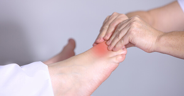 Schmerzbehandlung bei Gicht