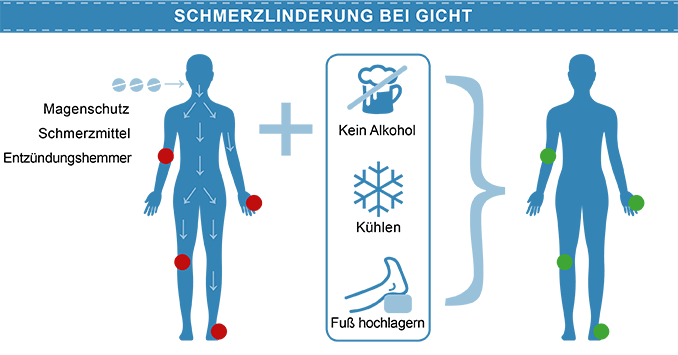 Schmerzlinderung bei Gicht: kein Alkohol, kühlen, Fuß hochlagern