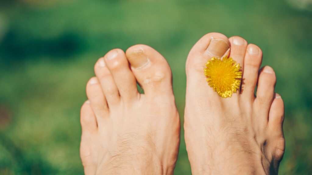 Gicht im Zeh – Was hilft schnell und warum trifft es gerade den großen Zeh?